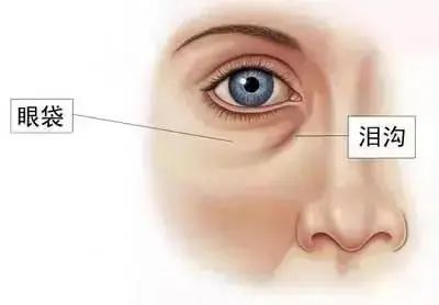祛一次眼袋能不能管终身?医生说就看这2个关键点! 图片-4