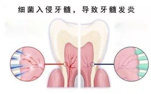 这些不起眼的小症状，竟能“侵蚀”一口好牙? 图片-3