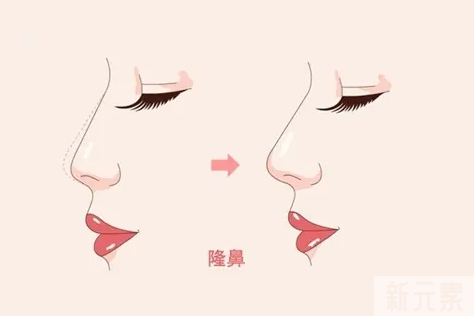 假体隆鼻材料怎么选择~~~ 图片-10