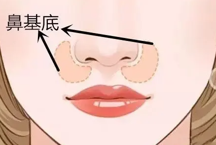 不同类型的法令纹，如何正确解决? 图片-3