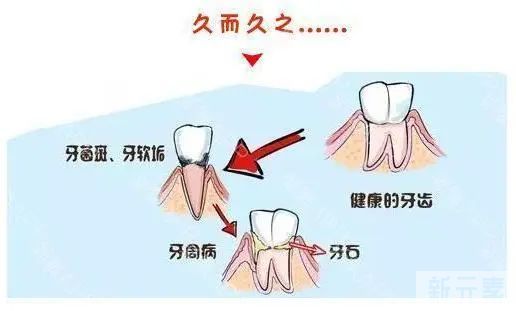 牙菌斑:细菌在口腔内开“派对”，你竟毫不知情! 图片-4