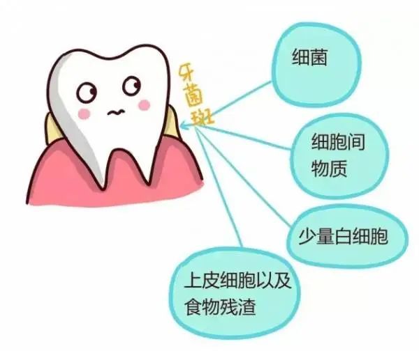 牙菌斑:细菌在口腔内开“派对”，你竟毫不知情! 图片-3
