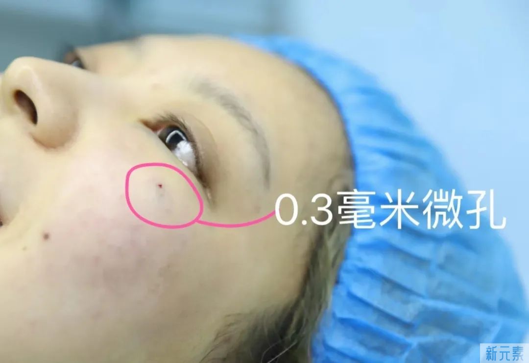 年轻人和中年人祛眼袋区别这么大?看完省了不少钱! 图片-6