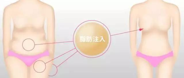 自体脂肪一定比假体好?隆胸材料该如何选? 图片-9
