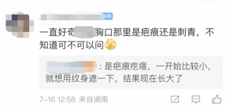 纹身虽好看，但需警惕留疤! 图片-5