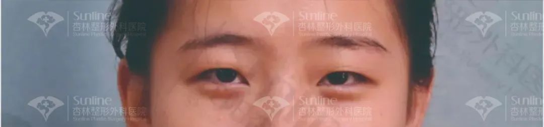 双眼皮真的越宽越好吗? 图片-9