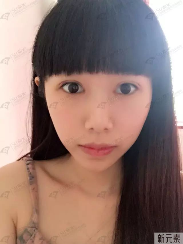 双眼皮真的越宽越好吗? 图片-15
