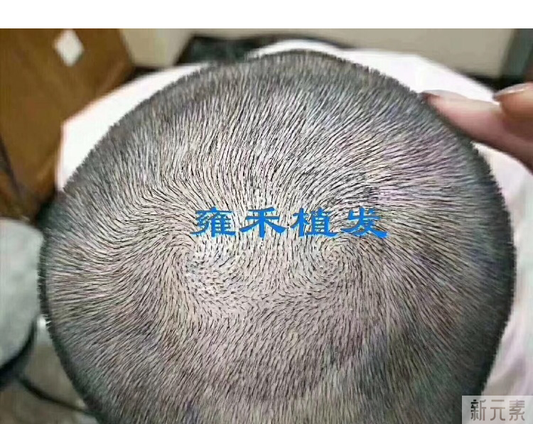 发旋稀疏是地中海秃头的前兆吗? 图片-7