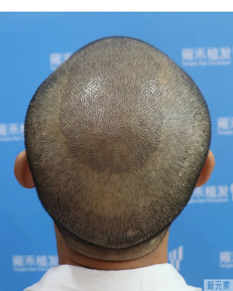 发旋稀疏是地中海秃头的前兆吗? 图片-6