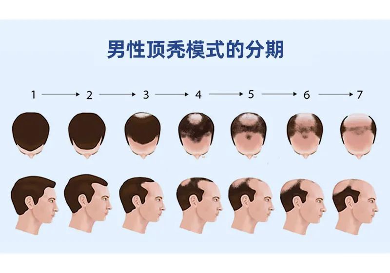 发旋稀疏是地中海秃头的前兆吗? 图片-2