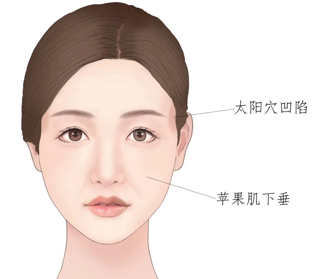 面部凹陷怎么办?手把手教你，速来围观! 图片-3