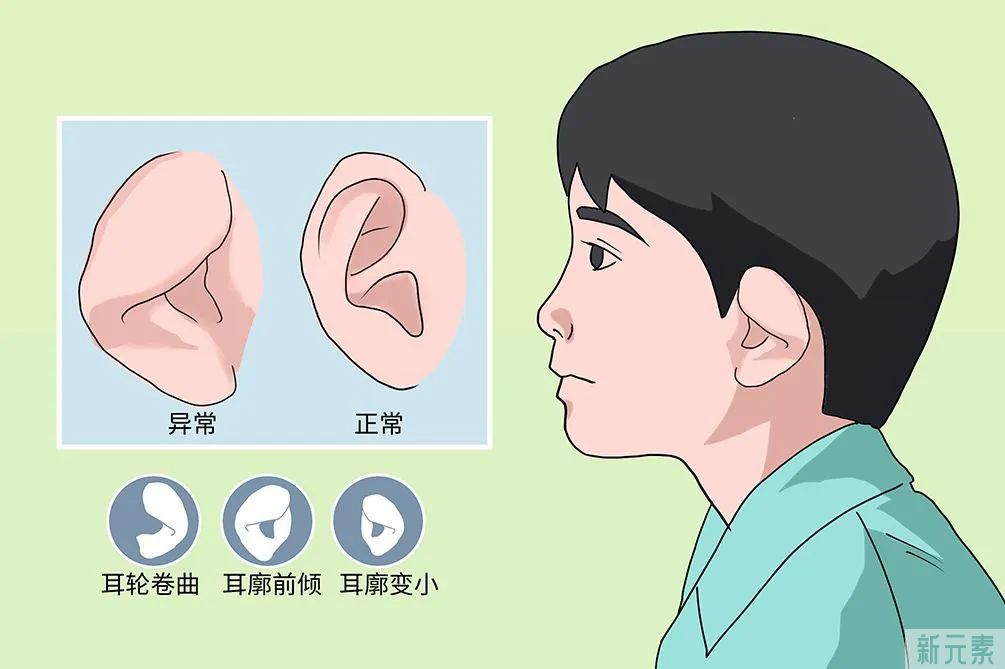 为什么孩子产检时没问题，出生后却是小耳畸形?该如何矫正? 图片-1