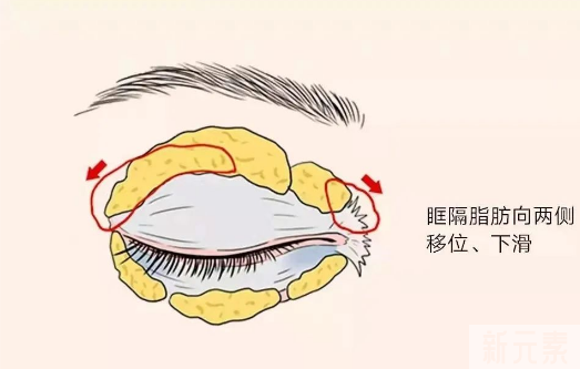 眼霜、眼部按摩仪祛不了眼袋，不要再花冤枉钱了! 图片-4
