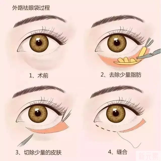 眼霜、眼部按摩仪祛不了眼袋，不要再花冤枉钱了! 图片-9