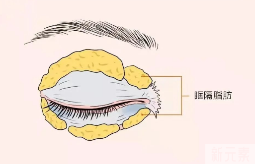 眼霜、眼部按摩仪祛不了眼袋，不要再花冤枉钱了! 图片-5