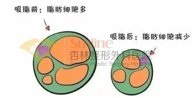 科普 | 吸脂前你需要知道这些! 图片-7
