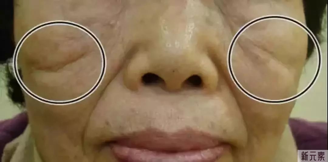科普 | 面部抗衰，你可能忽略了它 图片-2