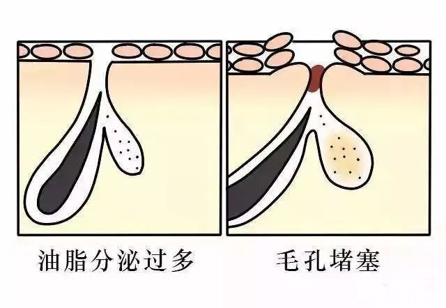 谁说毛孔粗大没有救了?我找到了细腻毛孔的办法 图片-2