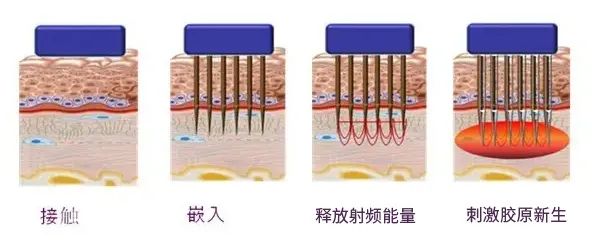 谁说毛孔粗大没有救了?我找到了细腻毛孔的办法 图片-8