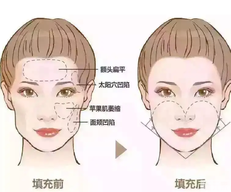 自体脂肪填充前，必须了解的12件事! 图片-2