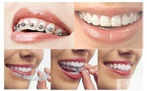 成人矫正也有黄金期吗?效果好不好? 图片-6