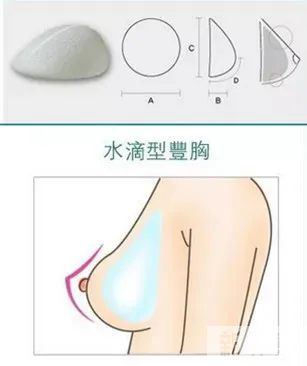 哪个年龄段适合做假体隆胸?如何才能大的自然?do胸前先看这一篇! 图片-10