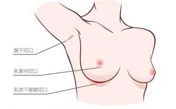 哪个年龄段适合做假体隆胸?如何才能大的自然?do胸前先看这一篇! 图片-8