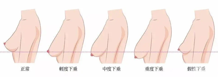 哪个年龄段适合做假体隆胸?如何才能大的自然?do胸前先看这一篇! 图片-11
