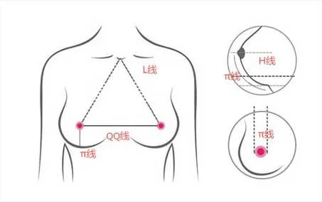 哪个年龄段适合做假体隆胸?如何才能大的自然?do胸前先看这一篇! 图片-13