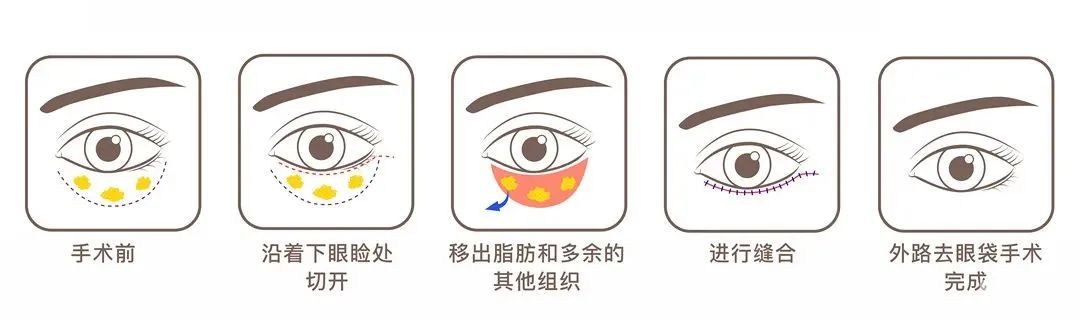眼袋去不掉?看看你是不是做了这几件事? 图片-10