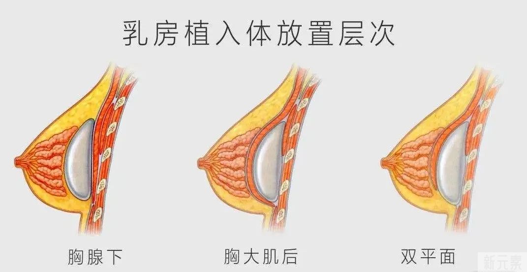 假体隆胸不自然，主要因为这两点! 图片-1