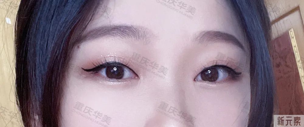 有这4种情况还不祛眼袋，再祛就难了，治疗费还得翻倍! 图片-8