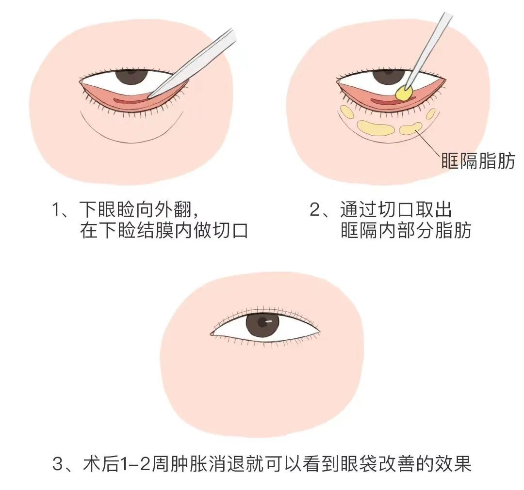 有这4种情况还不祛眼袋，再祛就难了，治疗费还得翻倍! 图片-7