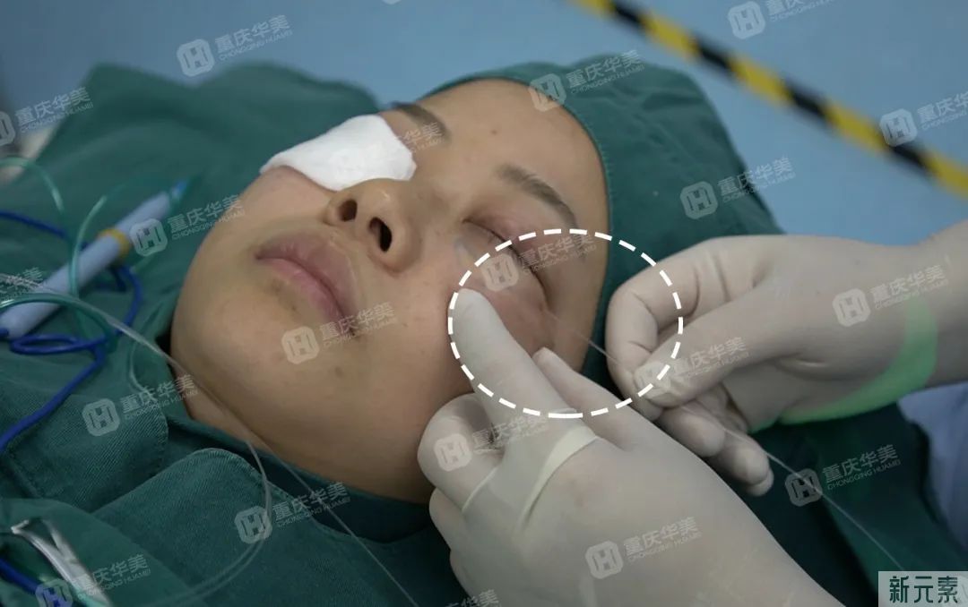 有这4种情况还不祛眼袋，再祛就难了，治疗费还得翻倍! 图片-12