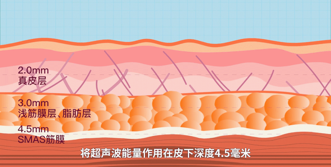超声炮、Fotona 4D Pro、热玛吉，抗衰怎么选? 图片-6