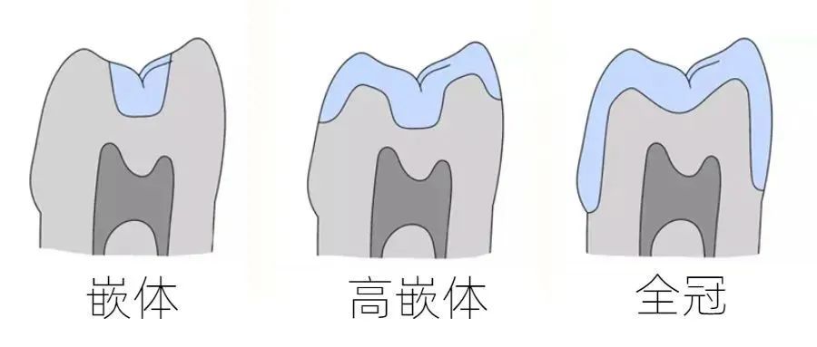 做完根管治疗后，该如何保护牙齿呢? 图片-3