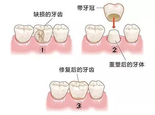 做完根管治疗后，该如何保护牙齿呢? 图片-5