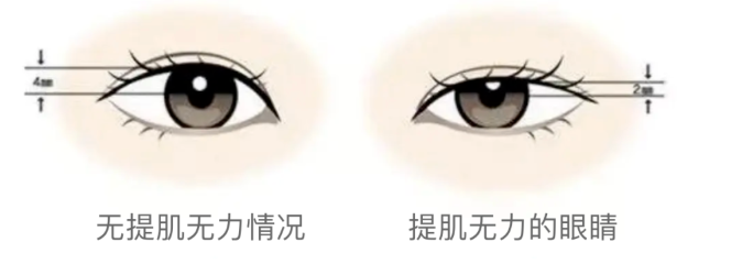 功课贴丨割双眼皮一定要做提肌吗? 图片-2