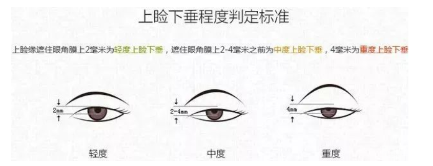 功课贴丨割双眼皮一定要做提肌吗? 图片-3
