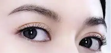 功课贴丨割双眼皮一定要做提肌吗? 图片-4
