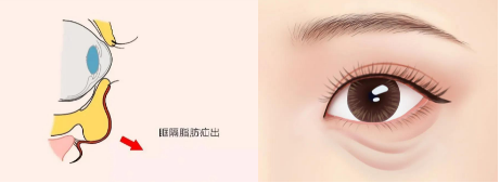 肿眼泡、眼袋、眼窝凹陷，三个不同的问题，都是TA在作妖 图片-5
