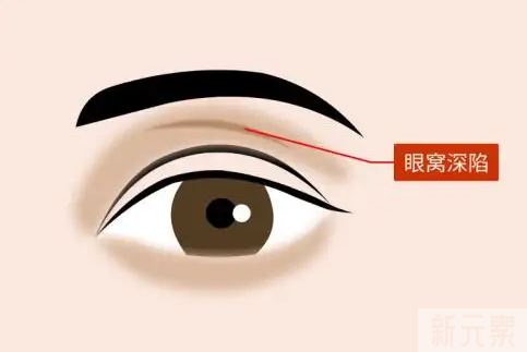 肿眼泡、眼袋、眼窝凹陷，三个不同的问题，都是TA在作妖 图片-8
