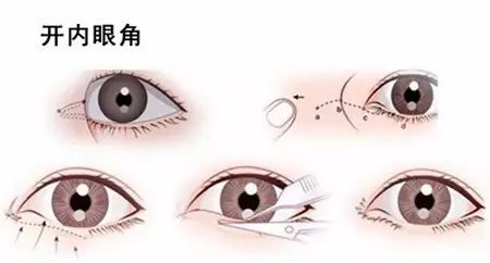 什么情况适合做开内眼角手术? 图片-6