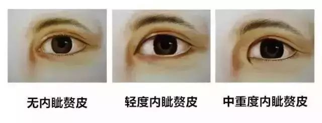什么情况适合做开内眼角手术? 图片-5