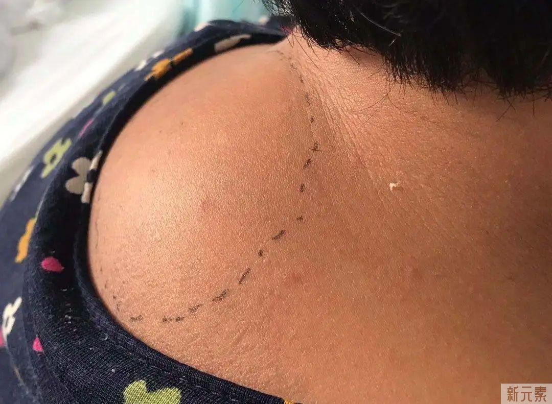 如何有效消除“富贵包”，选对方法很重要 图片-2