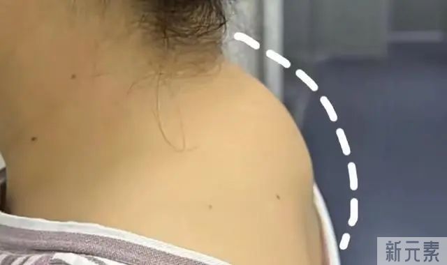 如何有效消除“富贵包”，选对方法很重要 图片-1
