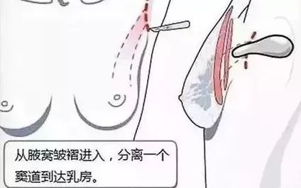 隆胸手术切口越小，术后的痕迹越小吗? 图片-7