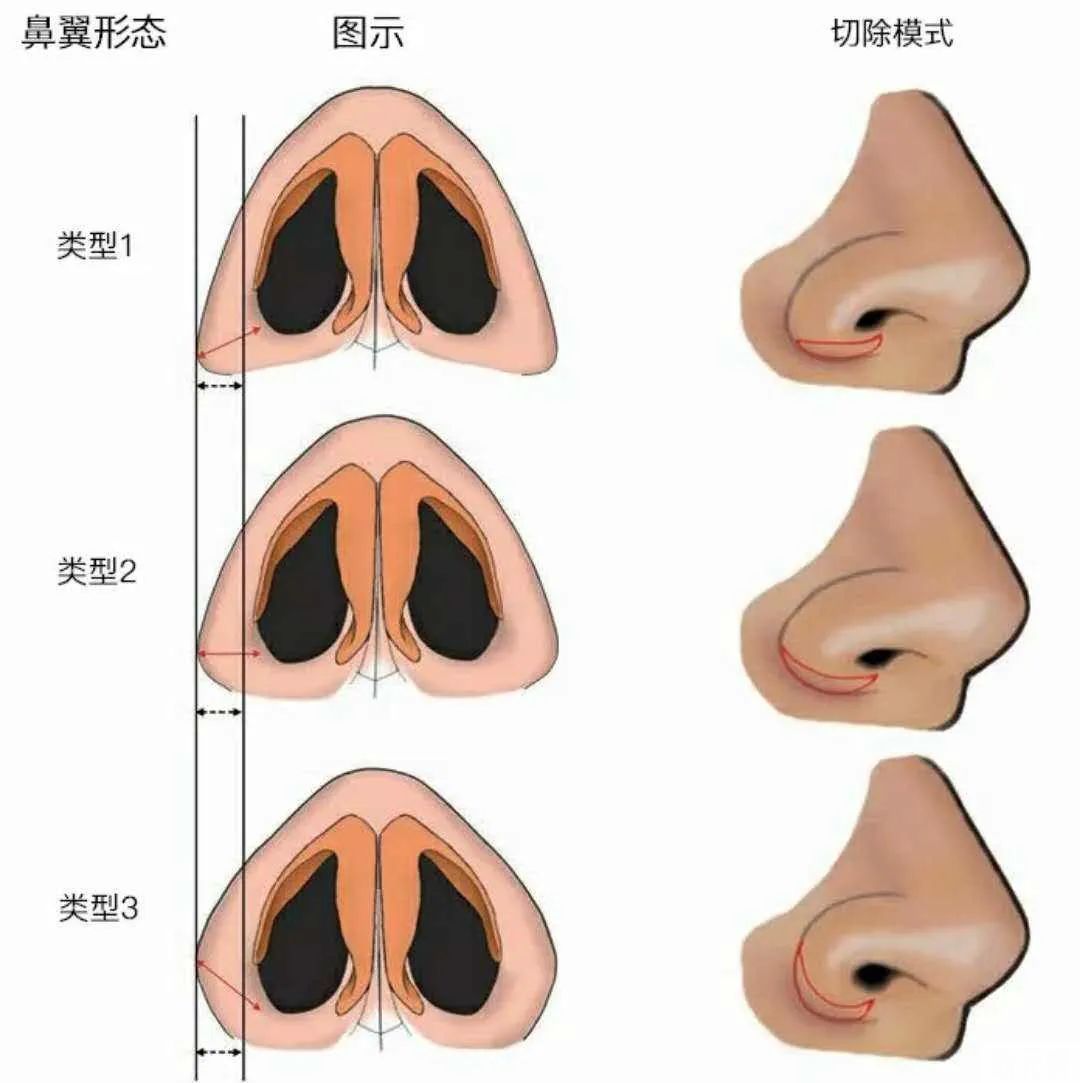 鼻子太宽、鼻翼太大，只做鼻翼缩小可以改善吗? 图片-14
