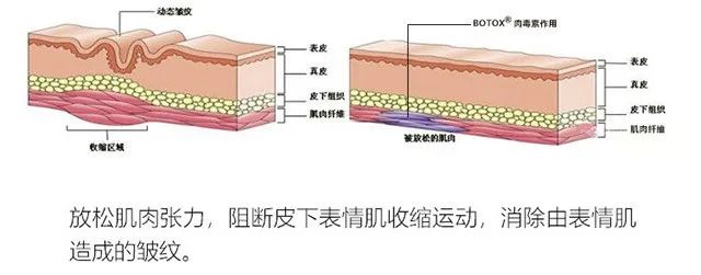 你的皱纹适合注射除皱吗? 图片-5