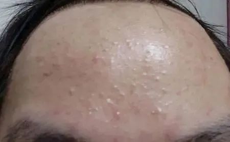 如何区分脂肪粒与粉刺?看这4点就够了 图片-4